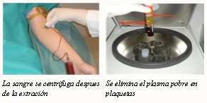 la sangre se centrifuga, se elimina el plasma pobre en plaquetas