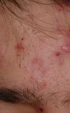 primeras fases de acne