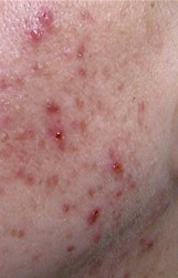 papulo pustulas y cicatrices de acne eliminables granada