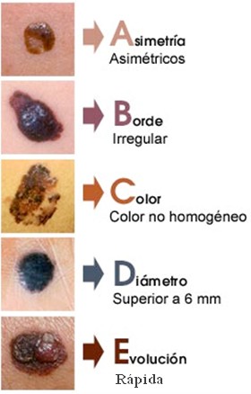 Cuadro de Fotos para detectar el cancer de piel