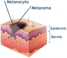 fotos de cancer en la piel, constitucion de la piel y donde comienza el melanoma y melanocyte