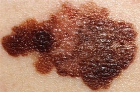 foto de melanoma o cancer de piel