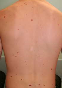 Fotos con manchas en la piel para detectar cancer piel