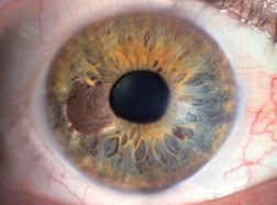 melanoma en el ojo, cancer en el ojo?