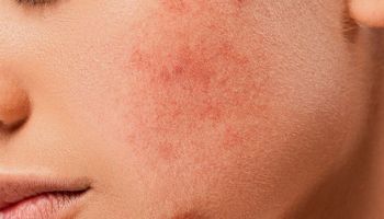 ACNE - CICATRICES