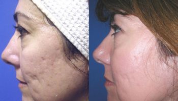 REJUVENECIMIENTO FACIAL